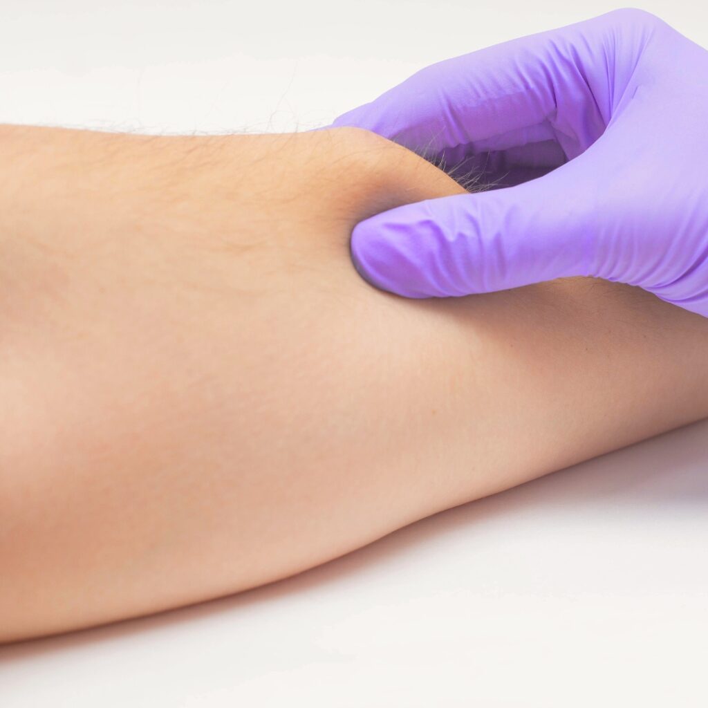 lipoma cyst removal dubai